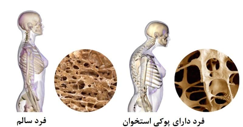 علائم، درمان و پیشگیری از پوکی استخوان